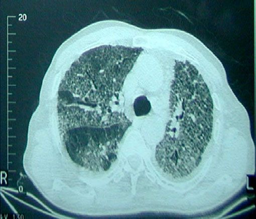 12/05/03 – Insuficiencia respiratoria subaguda con patrón reticular bilateral