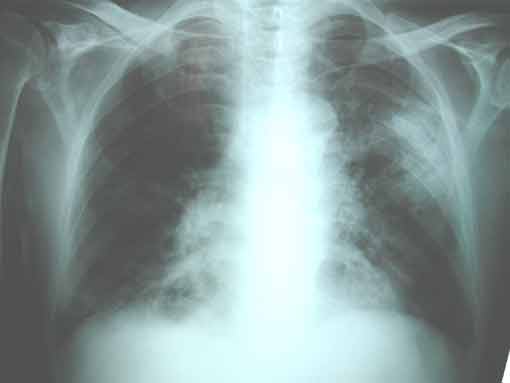 04/06/04 – Paciente con EPOC, fiebre y cavitaciones pulmonares múltiples