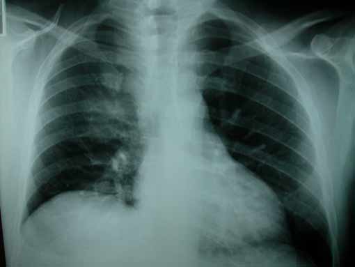 04/12/04 – Varón de 50 años con fiebre y alteraciones en la radiografía de torax